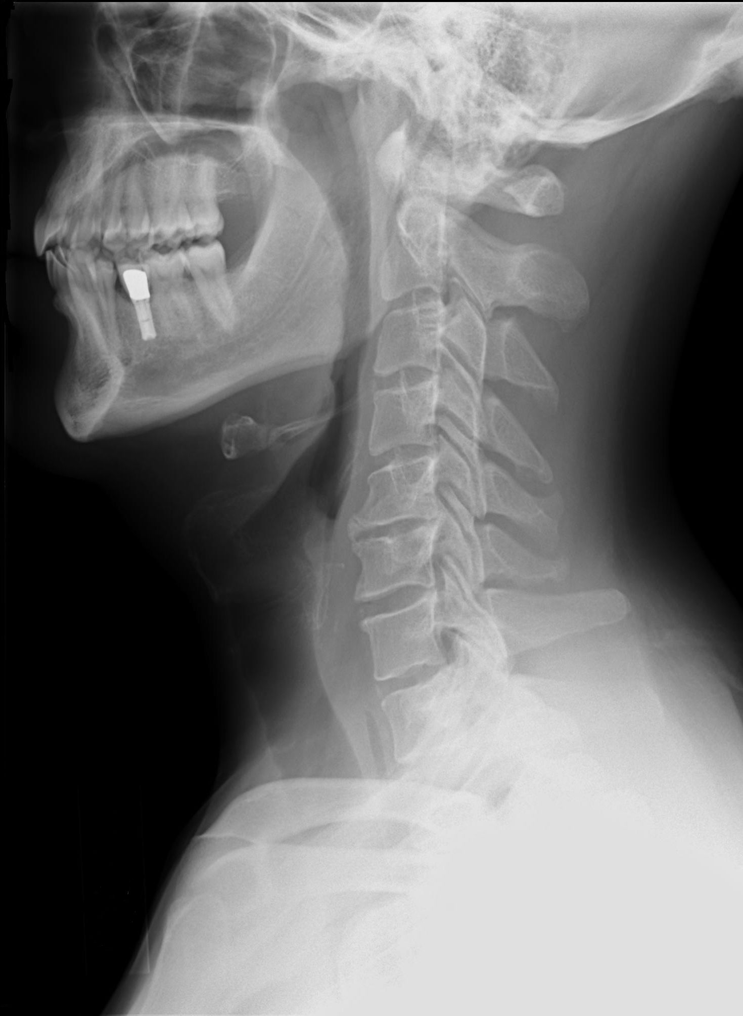 Davis Series X Ray Of Cervical Spine VKEWJD Davis Series X Ray Of Cervical Spine VKEWJD